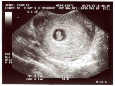 Losing the dream: pregnancy loss and how to&nbsp;cope