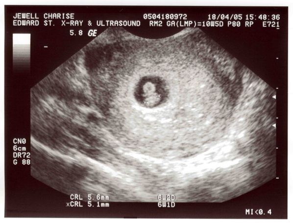 Grief after miscarriage or pregnancy loss